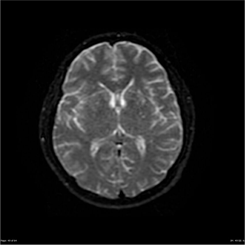 Amnestic syndrome secondary to hypoxic brain injury (Radiopaedia 24743-25004 DWI 49).jpg