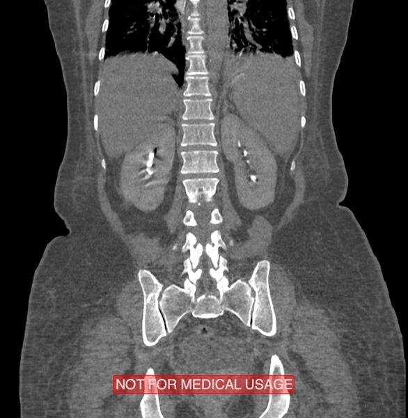 File:Amoebic enterocolitis with liver abscess (Radiopaedia 35100-36609 B 146).jpg