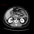 Ampullary carcinoma (Radiopaedia 56396-63056 C 44).jpg