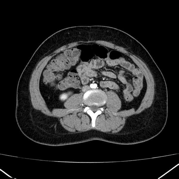 File:Ampullary tumor (Radiopaedia 22787-22816 B 53).jpg