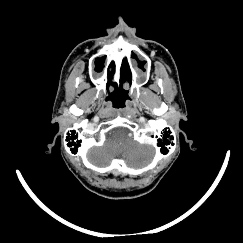 Anaplastic thyroid carcinoma (Radiopaedia 79087-92034 B 111).jpg
