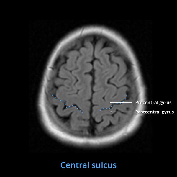 File:Anatomy- sulci of the brain (Radiopaedia 33834-34995 Central sulcus 2).jpg