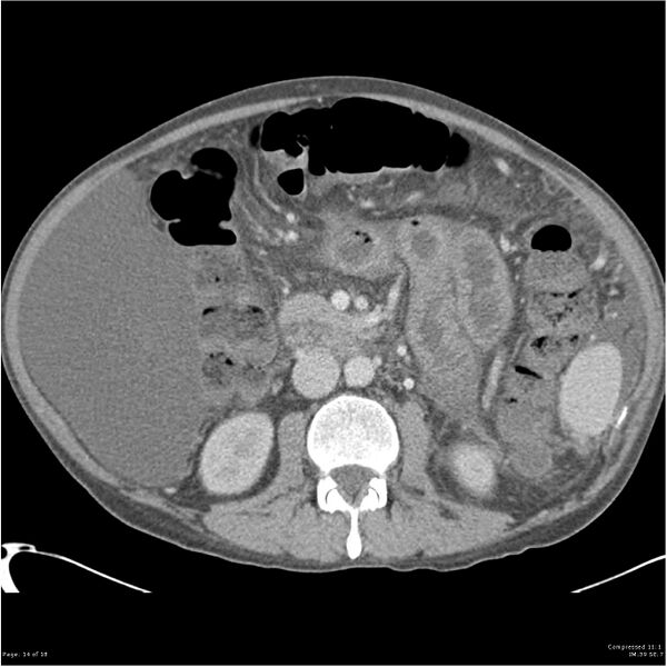 File:Annular pancreas and cirrhosis (Radiopaedia 24561-24843 A 14).jpg