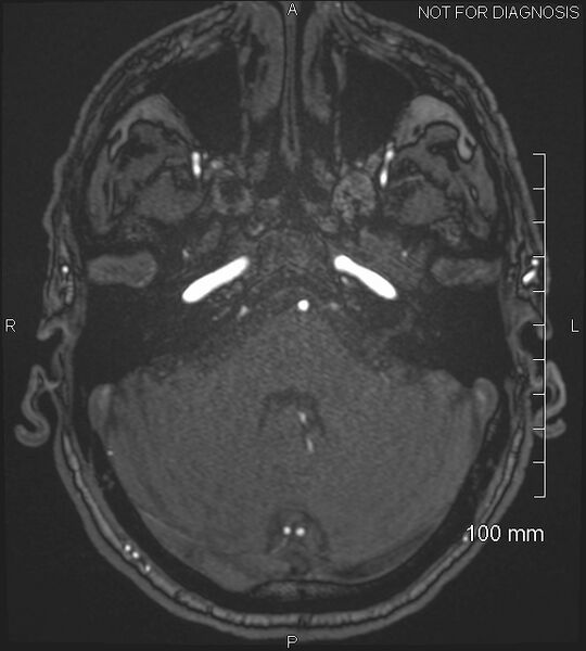 File:Anterior cerebral artery aneurysm (Radiopaedia 80683-94127 Axial MRA 51).jpg