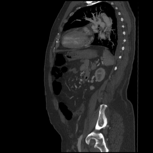 File:Aortic dissection (Radiopaedia 28802-29105 C 2).jpg