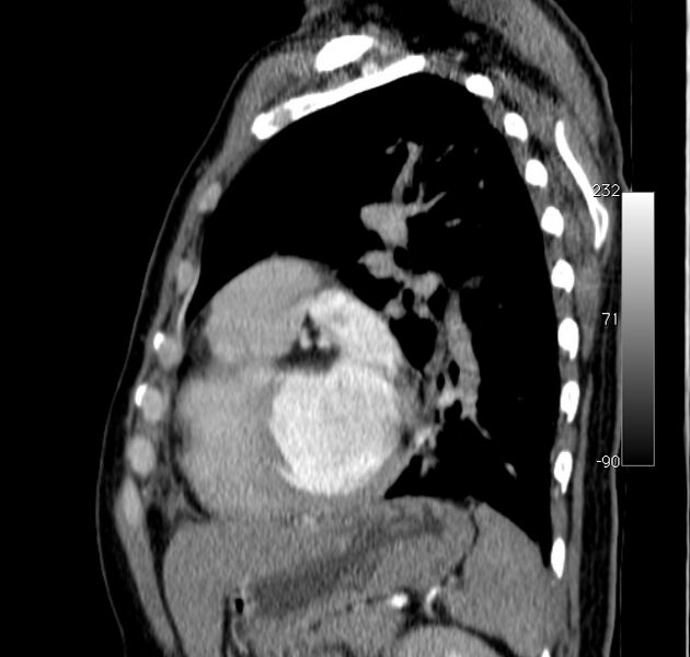 File:Aortic dissection - Stanford type A (Radiopaedia 29247-29659 C 14).jpg