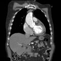 Aortic dissection with rupture into pericardium (Radiopaedia 12384-12647 B 14).jpg