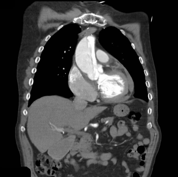 File:Aortic dissection with rupture into pericardium (Radiopaedia 12384-12647 B 14).jpg