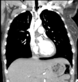 Aortic valve non-coronary cusp thrombus (Radiopaedia 55661-62189 C 34).png