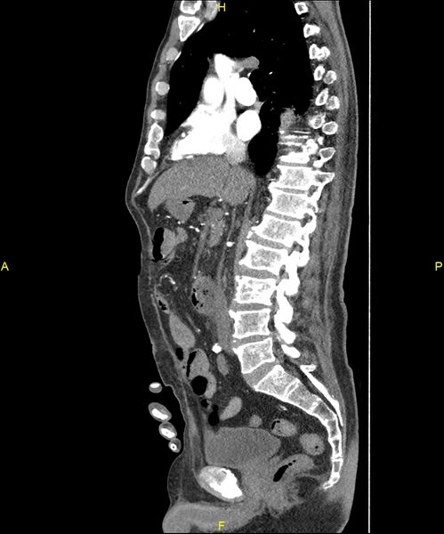File:Aortoenteric fistula (Radiopaedia 84308-99603 C 161).jpg