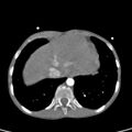 Aortopulmonary window, interrupted aortic arch and large PDA giving the descending aorta (Radiopaedia 35573-37074 B 79).jpg