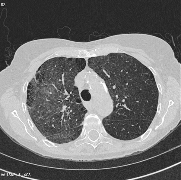 File:Apical non-small-cell lung cancer (Radiopaedia 8570-9405 Axial lung window 15).jpg