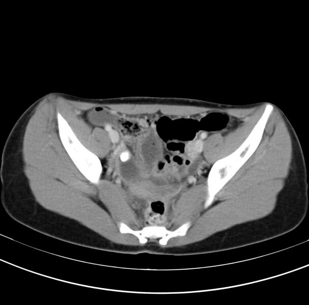 File:Appendicitis and incidental bicornuate uterus (Radiopaedia 22833-22853 B 38).jpg