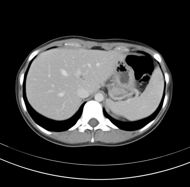 File:Appendicitis and incidental bicornuate uterus (Radiopaedia 22833-22853 B 8).jpg