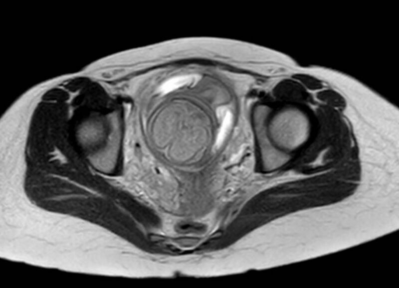 File:Appendicitis in gravida (MRI) (Radiopaedia 89433-106395 Axial T2 63).jpg