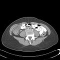 Appendicitis with minimal stranding but appendicolith (Radiopaedia 29035-29397 A 52).jpg