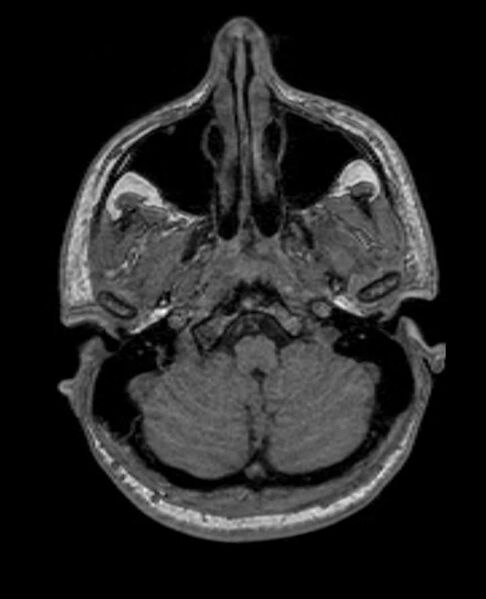 File:Arachnoid cyst- extremely large (Radiopaedia 68741-78451 Axial T1 14).jpg
