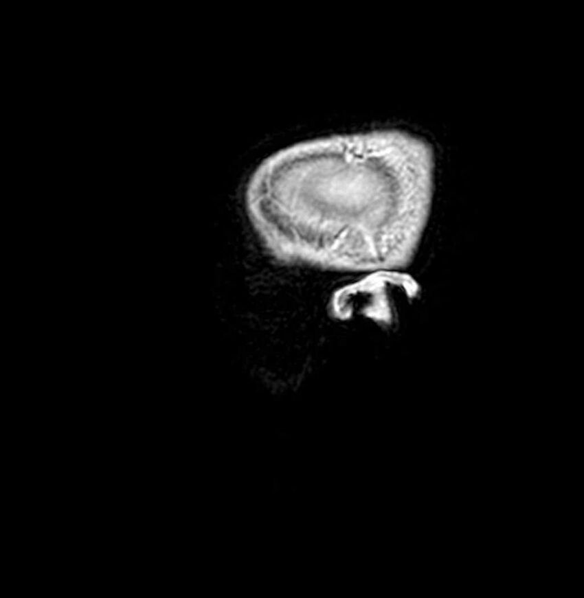 Arachnoid cyst- extremely large (Radiopaedia 68741-78451 Sagittal T1 C+ 74).jpg
