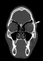 Arrow injury to the head (Radiopaedia 75266-86388 Coronal bone window 27).jpg