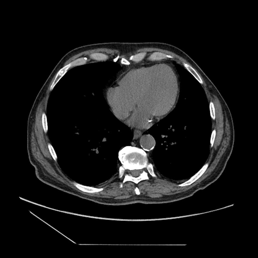 Asbestosis complicated by lung cancer (Radiopaedia 45834-50116 Axial non-contrast 45).jpg