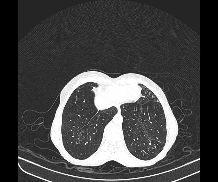 Aspergillomas (Radiopaedia 66779-76110 Axial lung window 38).jpg