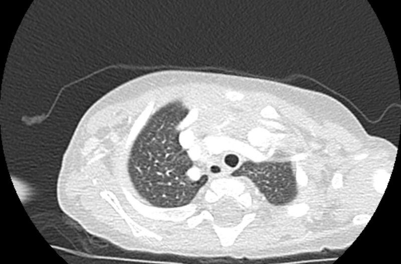 File:Asplenia syndrome (Radiopaedia 73083-83792 Axial lung window 9).jpg