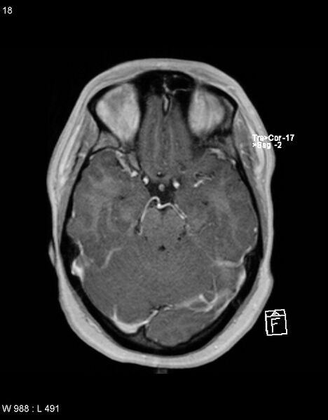 File:Astroblastoma (Radiopaedia 39792-42217 Axial T1 C+ 17).jpg
