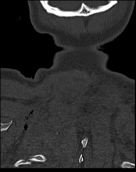 File:Atlanto-occipital dissociation - Traynelis type 1 (Radiopaedia 87570-103948 Coronal bone window 58).jpg