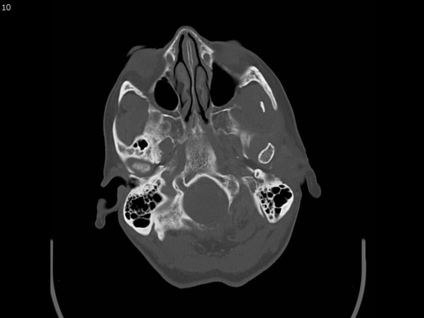 Atypical meningioma - intraosseous (Radiopaedia 64915-73867 Axial C+ bone window 10).jpg