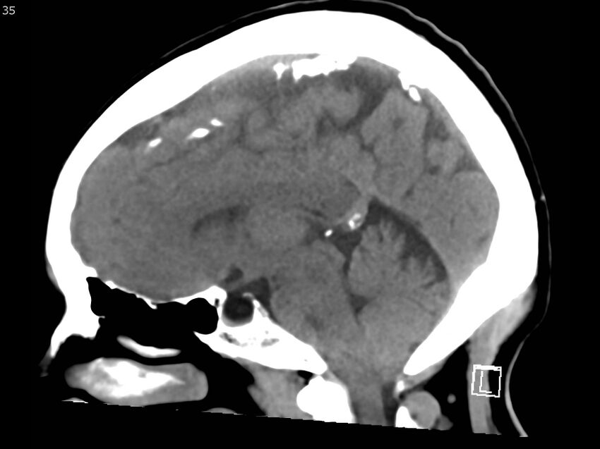 Atypical meningioma - intraosseous (Radiopaedia 64915-73867 C 33).jpg