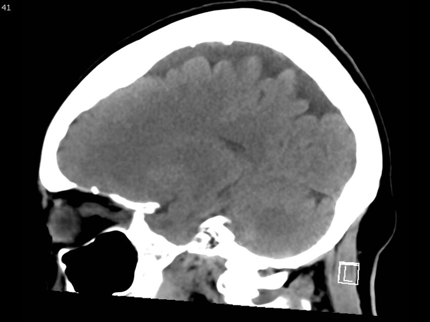 Atypical meningioma - intraosseous (Radiopaedia 64915-73867 C 39).jpg