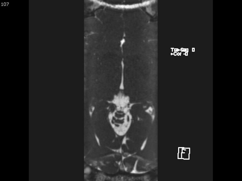 File:Atypical meningioma - intraosseous (Radiopaedia 64915-74572 Axial CISS 107).jpg