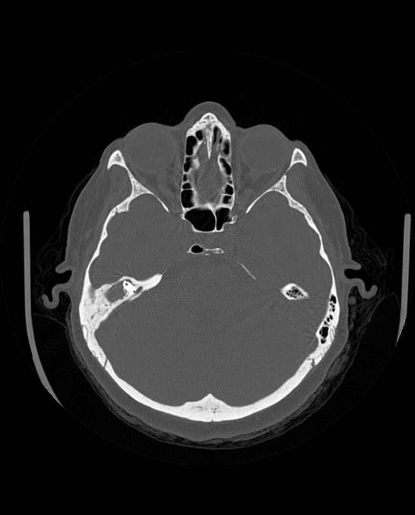 Automastoidectomy with labyrinthine fistula (Radiopaedia 84143-99411 Axial non-contrast 101).jpg