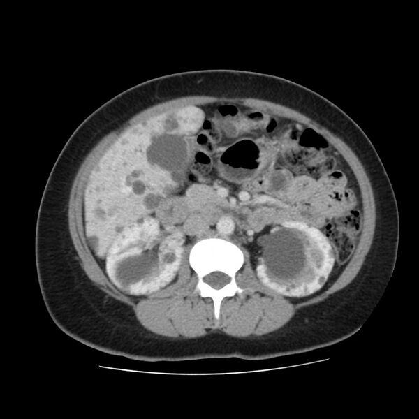 File:Autosomal dominant polycystic kidney disease (Radiopaedia 23061-23093 C 28).jpg