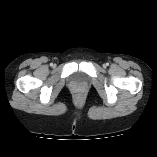 File:Autosomal dominant polycystic kidney disease (Radiopaedia 23061-23093 C 73).jpg