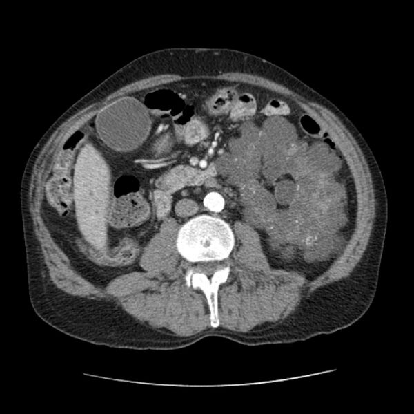 File:Autosomal dominant polycystic kidney disease (Radiopaedia 27851-28094 B 77).jpg