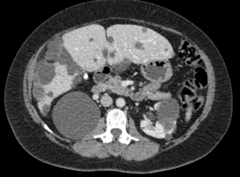 File:Autosomal dominant polycystic kidney disease (Radiopaedia 57124-64017 A 51).jpg