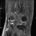 Avulsion fracture of the fibular head (Radiopaedia 74804-85808 Coronal PD fat sat 28).jpg