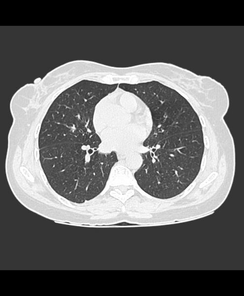 File:Azygos fissure and azygos lobe (Radiopaedia 41841-44832 Axial lung window 11).jpg