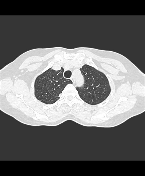 File:Azygos fissure and azygos lobe (Radiopaedia 41841-44832 Axial lung window 28).jpg