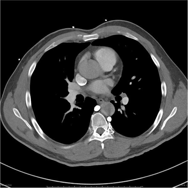 File:Azygos venous system anatomy (CT pulmonary angiography) (Radiopaedia 25928-26077 Axial C+ CTPA 44).jpg