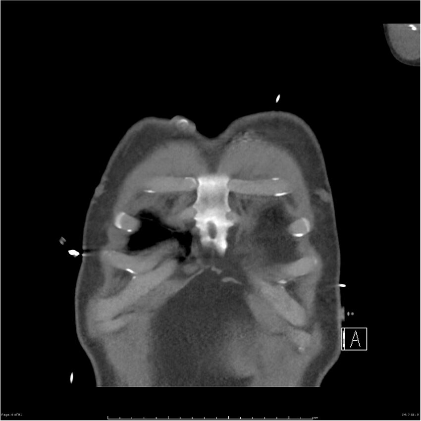 Azygos venous system anatomy (CT pulmonary angiography) (Radiopaedia 25928-26077 Coronal C+ CTPA 6).jpg
