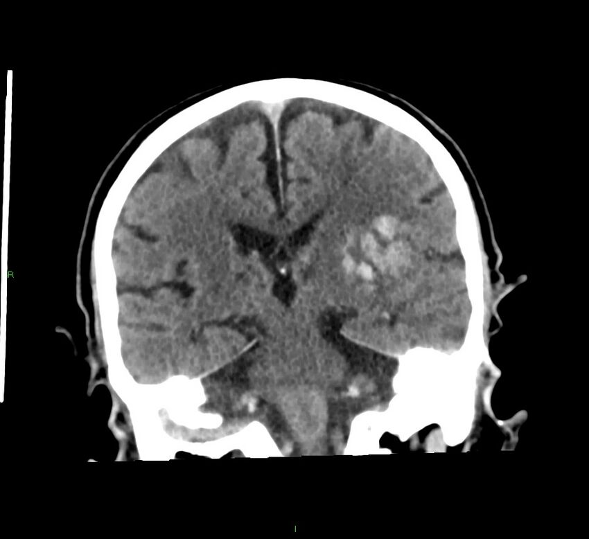 Basal ganglia hemorrhage (Radiopaedia 58791-66025 Coronal non-contrast 28).jpg