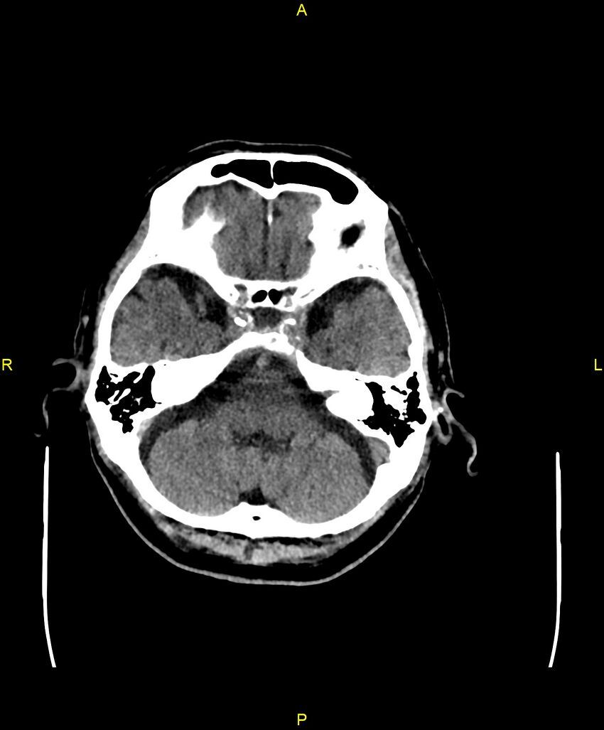 Bilateral isodense subdural hematomas (Radiopaedia 88621-105325 Axial non-contrast 24).jpg
