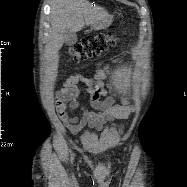 File:Bilateral medullary nephrocalcinosis with ureteric calculi (Radiopaedia 71269-81569 Coronal non-contrast 15).jpg
