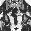 Bilateral ovarian endometriomas (Radiopaedia 87085-103347 Coronal T2 16).jpg