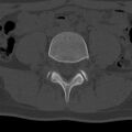Bilateral pars defect (Radiopaedia 26691-26846 Axial bone window 35).jpg