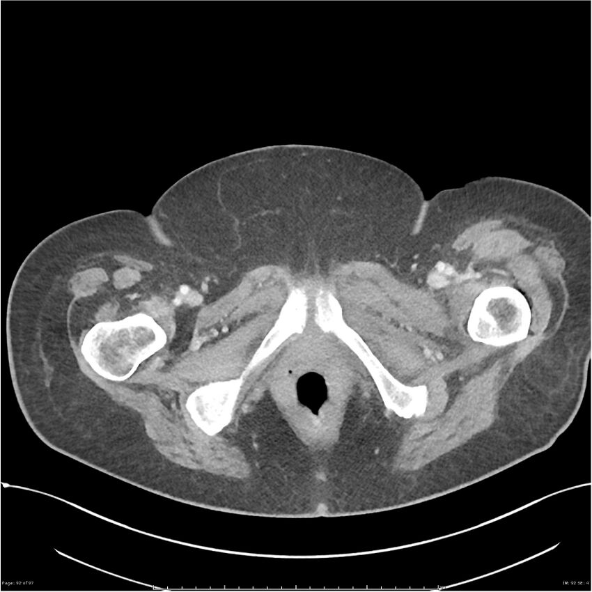 Bilateral psoas hematomas (Radiopaedia 24057-24279 A 92).jpg