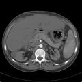 Biliary necrosis - liver transplant (Radiopaedia 21876-21846 A 27).jpg