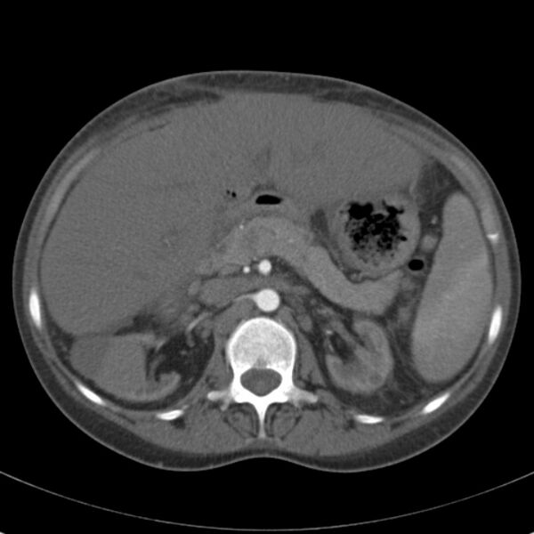 File:Biliary necrosis - liver transplant (Radiopaedia 21876-21846 A 27).jpg